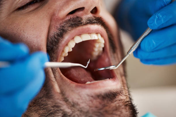 Best Emergency Dentist for Lost Fillings or Crowns in Dodgeville, WI